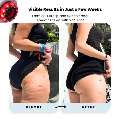 Vacuvia® SculptGlow™ – Firmer, More Toned Skin